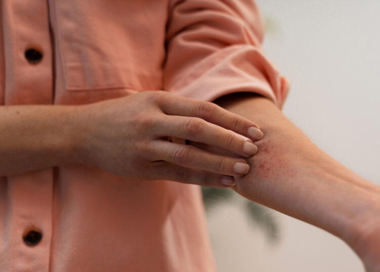 Everything You Should Know About Lyme Disease and Its Symptoms